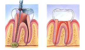 Root Canal Therapy